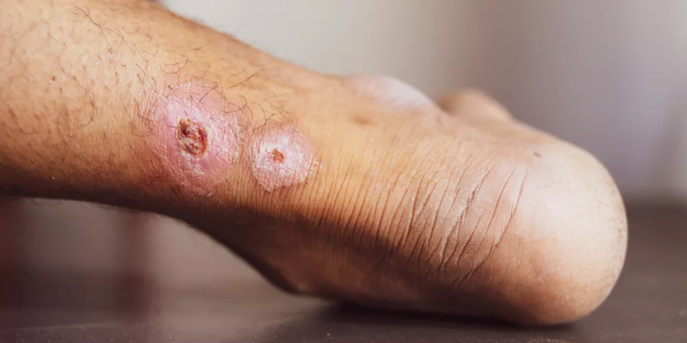 Beriberi disease4