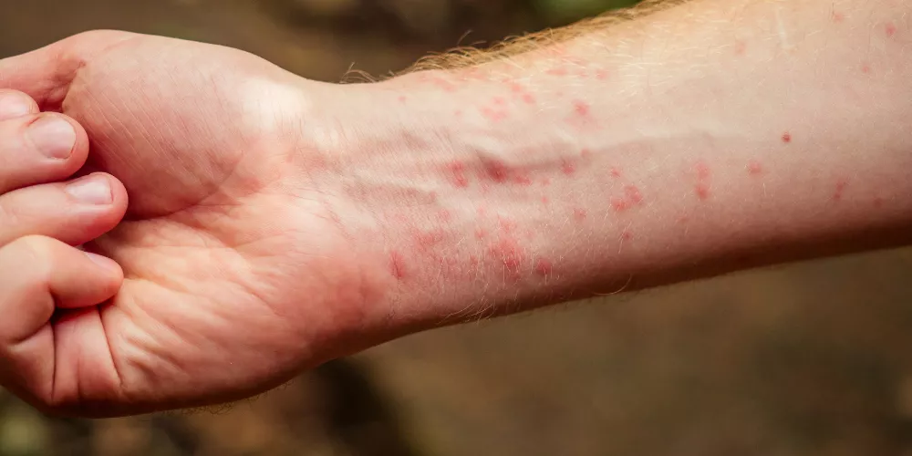 Itching on the body2