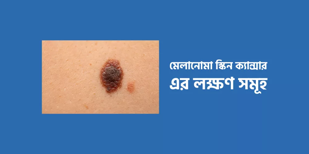Melanoma skin cancer1