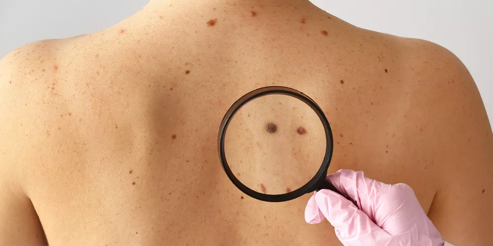Melanoma skin cancer2