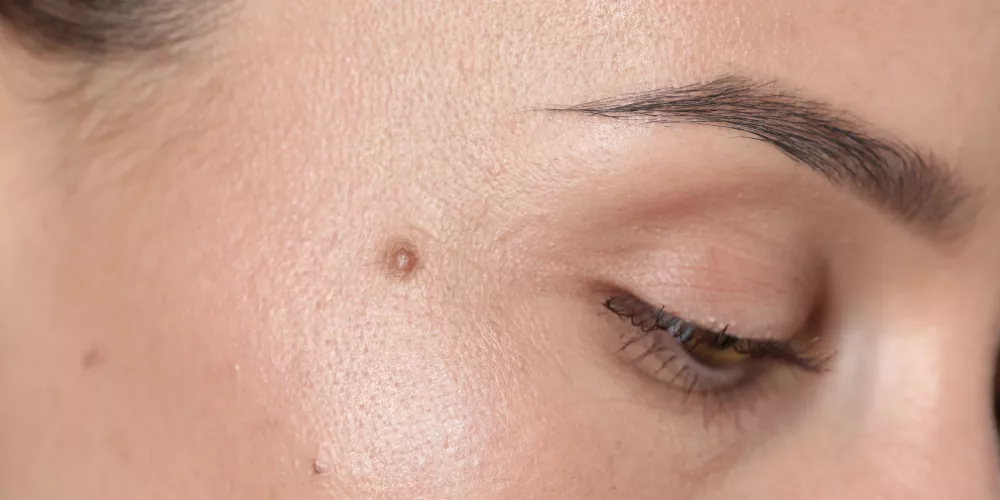 Melanoma skin cancer3